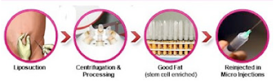 cell-assisted lipotransfer